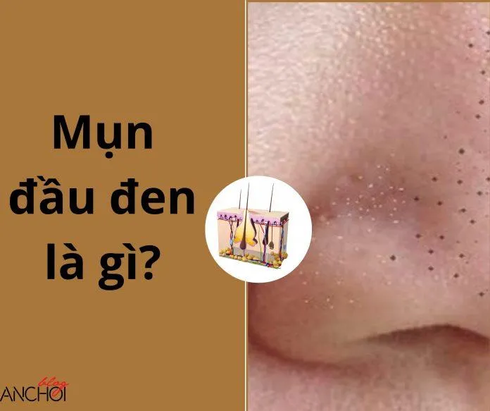 Mụn đầu đen là một dạng mụn trứng nhưng không gây viêm ( Nguồn: Blogphunu.edu.vn)