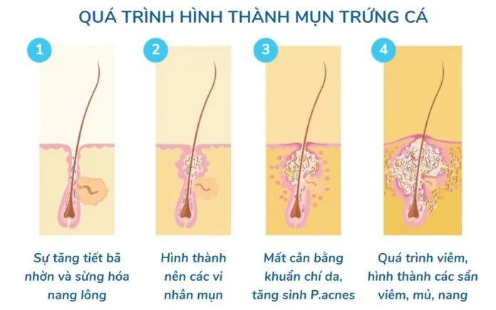 Isotretinoin sẽ hạn chế tuyến bã nhờn hoạt động quá mức, từ đó hạn chế nguyên nhân gây mụn (Nguồn: Internet).