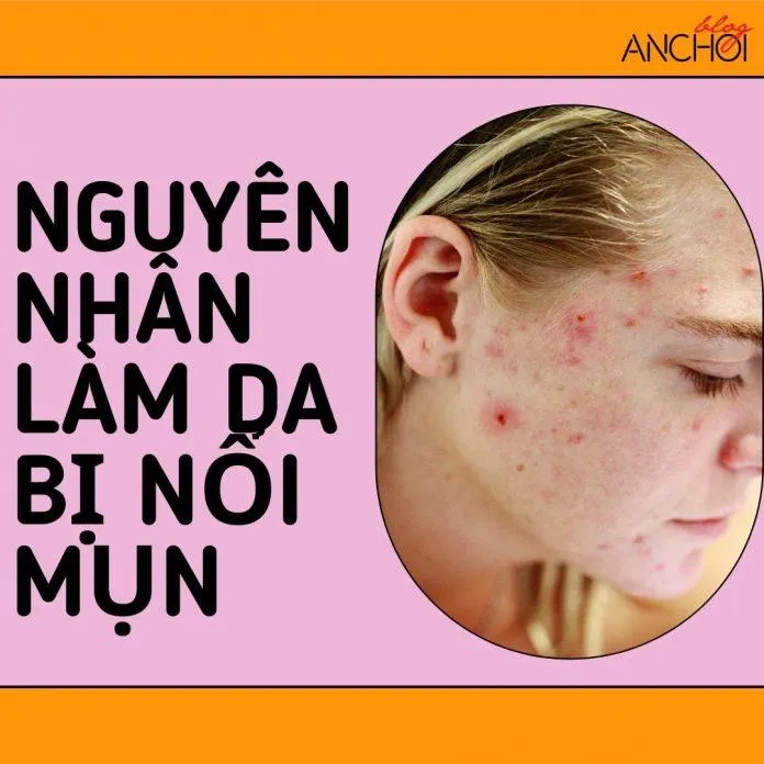 Có rất nhiều nguyên nhân làm da bị nổi mụn các nàng nên tìm hiểu để khắc phục nhá (nguồn: Blogphunu.edu.vn)