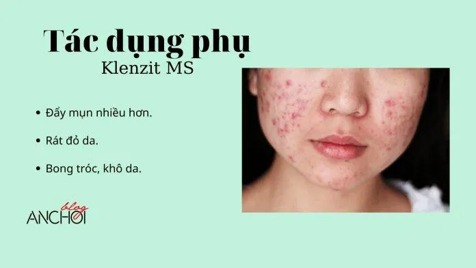 Review gel trị mụn Klenzit MS: xóa bỏ mụn viêm, mang lại làn da sạch mụn