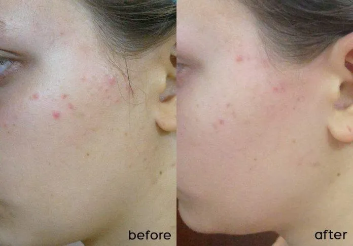 Trước và sau khi sử dụng kem dưỡng SVR SEBIACLEAR Mat + Pores