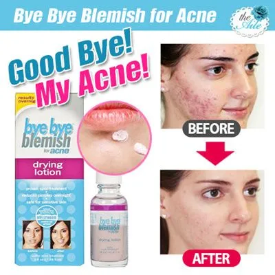 Kem trị mụn Bye Bye Blemish