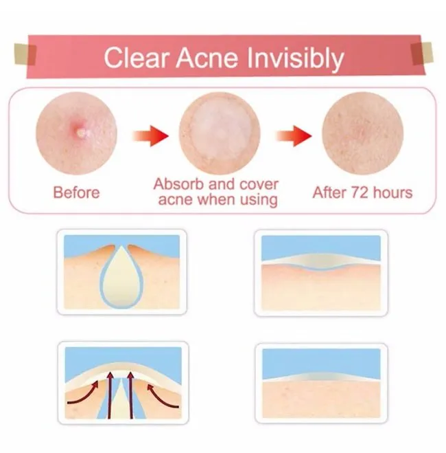 Miếng dán mụn Some By Mi Clear Spot Patch