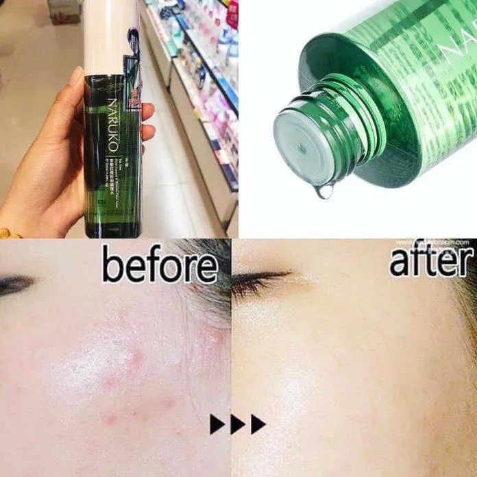 Khả năng trị mụn của Naruko Tea Tree Toner rất tốt (Nguồn: Internet)