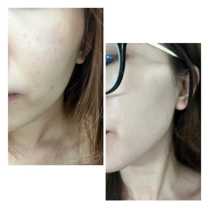 Da mặt mình trước và sau khi uống combo 2 sản phẩm. (Nguồn: Blogphunu.edu.vn)