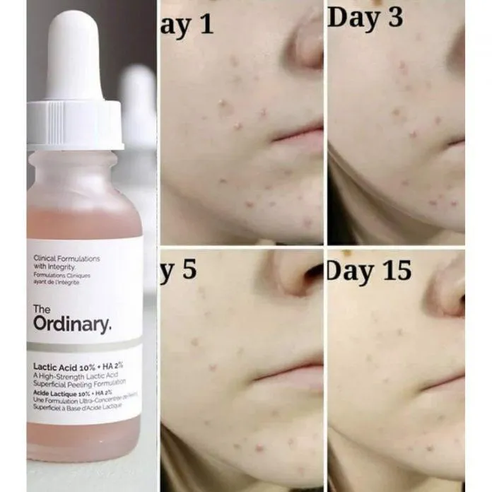 The Ordinary Lactic Acid 10% + HA cực kì phù hợp với những bạn mới sử dụng hoặc có làn da khô (Nguồn: Internet)