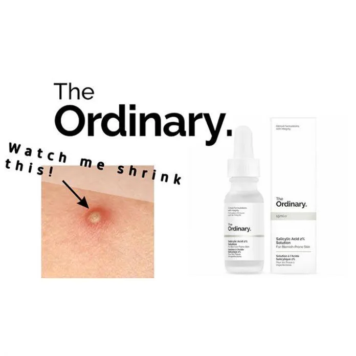 Tinh chất trị mụn The Ordinary Salicylic Acid 2% Solution có khả năng trị mụn rất tốt. (nguồn: Internet)