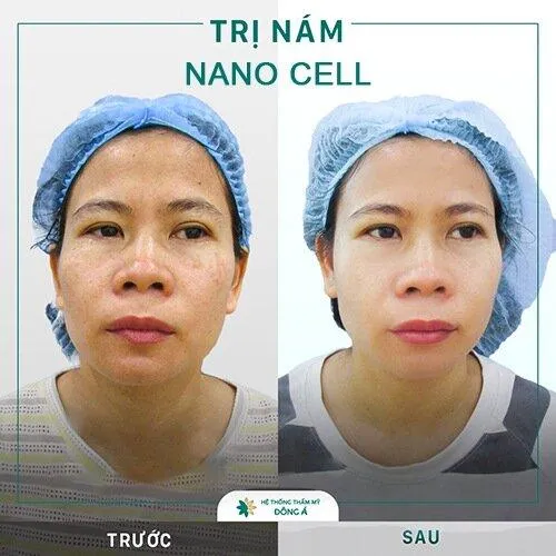 Đông Á áp dụng công nghệ Nano Cell điều trị nám da (Nguồn: Đông Á)